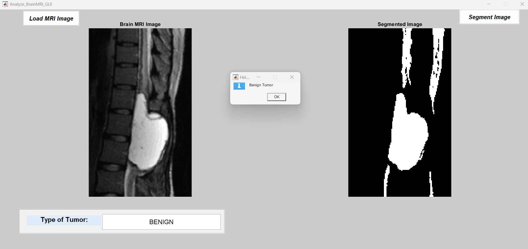 Brain Tumor GUI